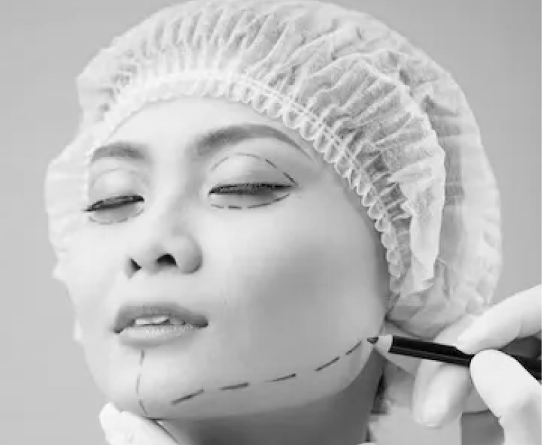 Midface Lift