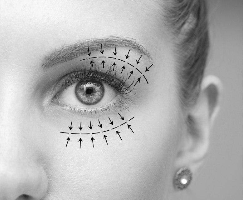 Upper Blepharoplasty