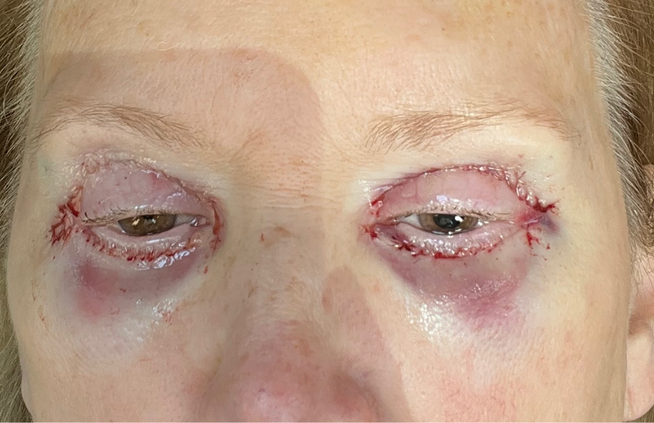 Post-op Day 0