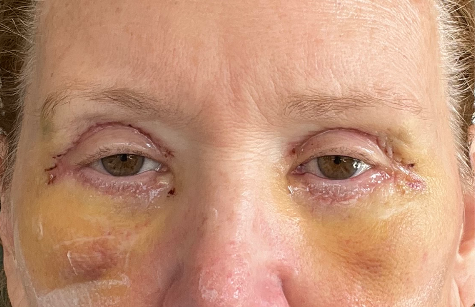 Post-op Day 5