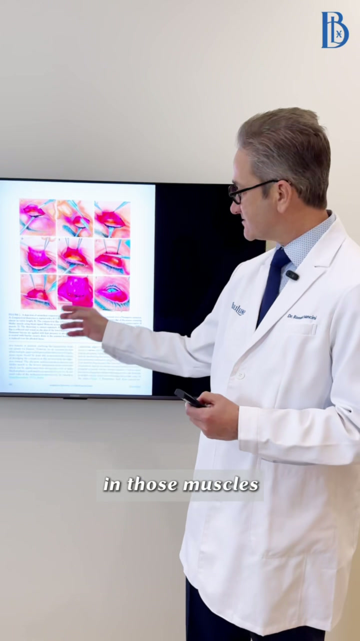 Conjunctiva-sparing ptosis repair video 2
