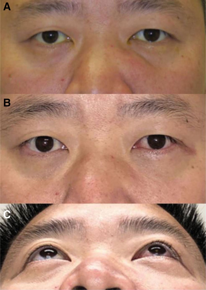 Orbital Floor & Rim Reconstruction with Titanium Implant