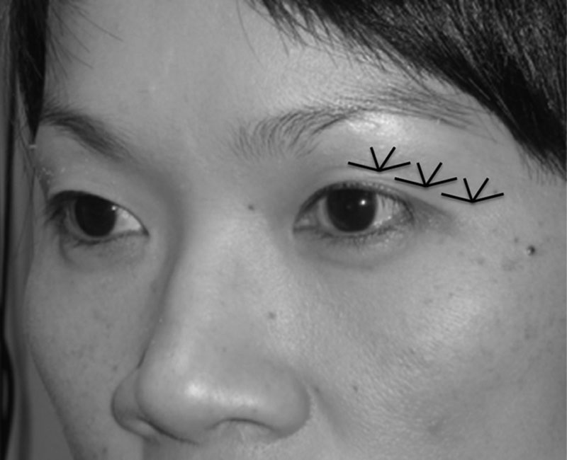 Asian patient with markings showing eyelid folds