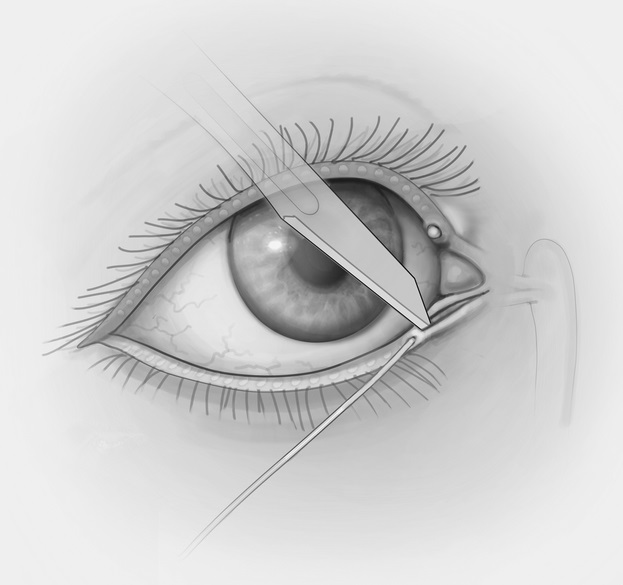 Illustration of punctum-sparing canaliculotomy