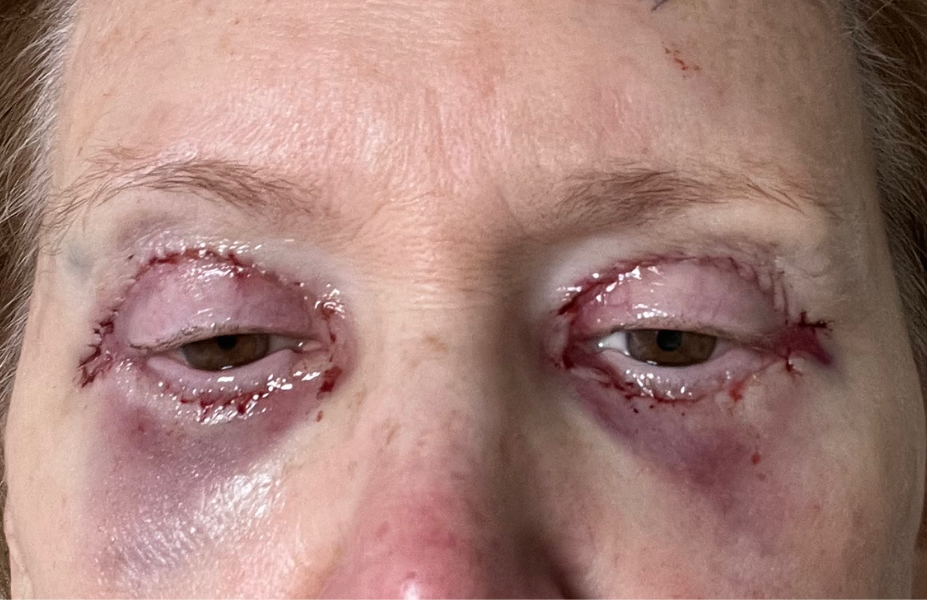 Post-op Day 0