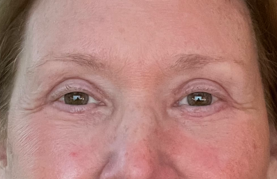 Post-op Month 1