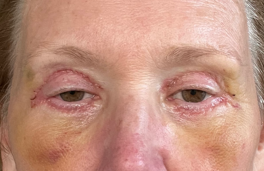 Post-op Day 6