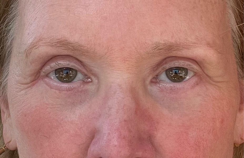 Post-op Day 14