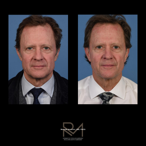 Dr. Jeffrey Kenkel before eyelid surgery side profile