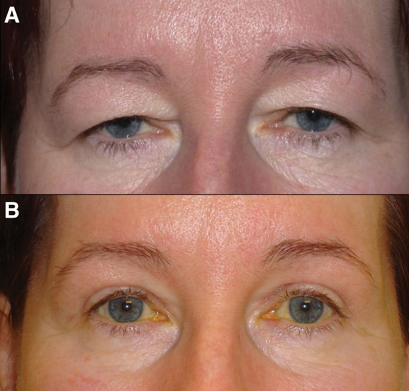 The Tuck and Rise Brow Lift Technique