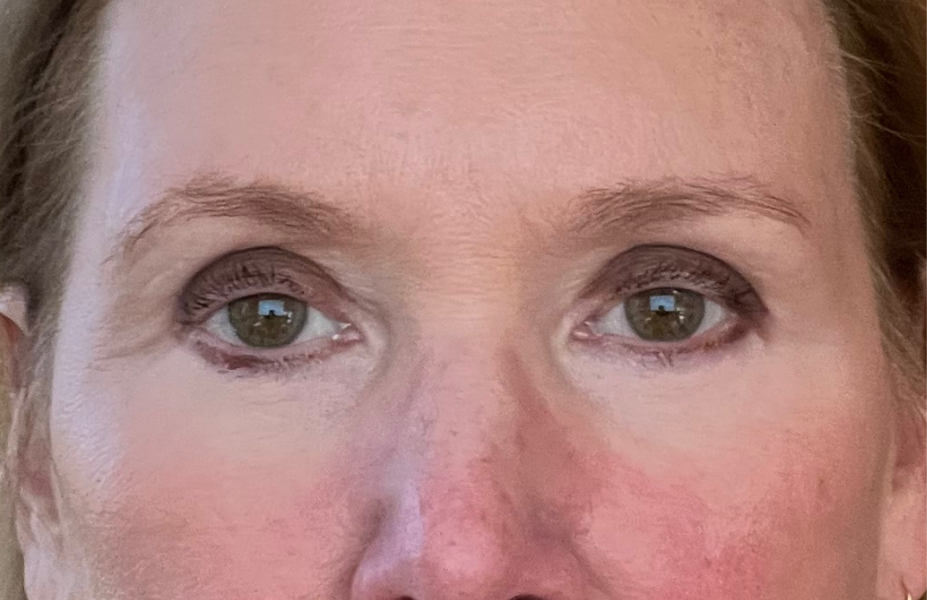 Post-op Month 6