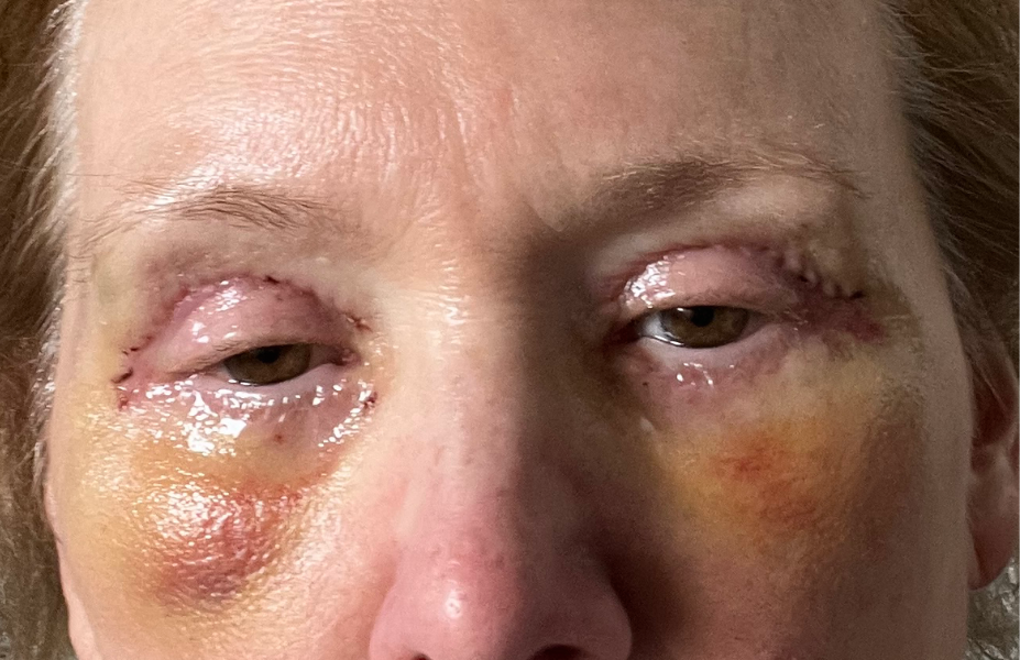 Post-op Day 4
