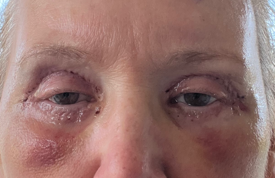 Post-op Day 3