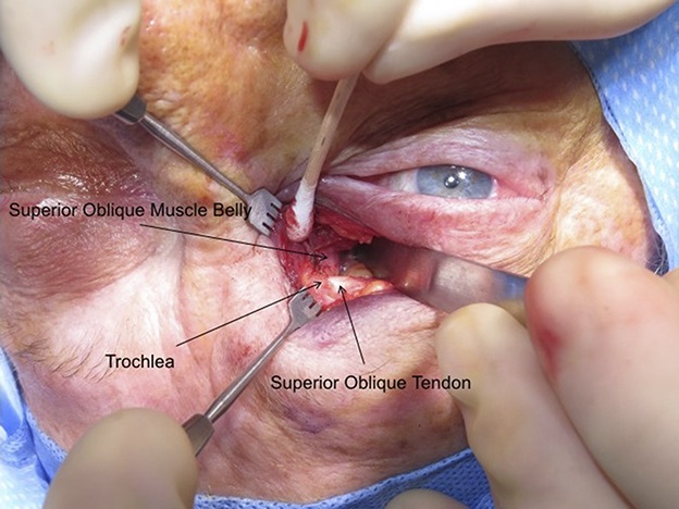 Orbital floor and rim reconstruction case study