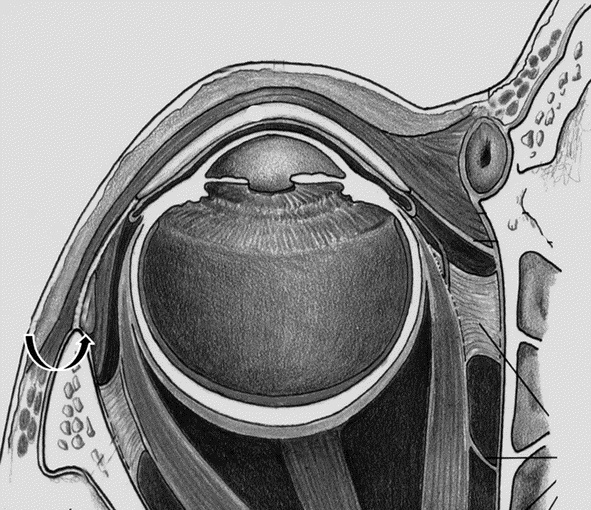 Upper Eyelid Approach to Lower Eyelid Blepharoplasty