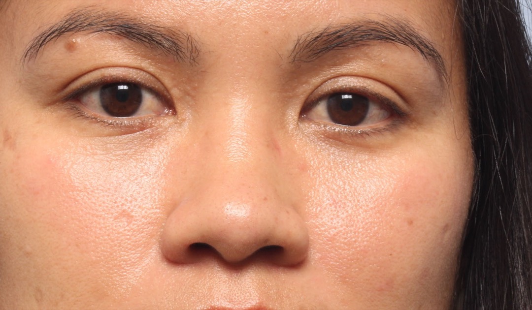 Patient # 15 3 Months Post-Op