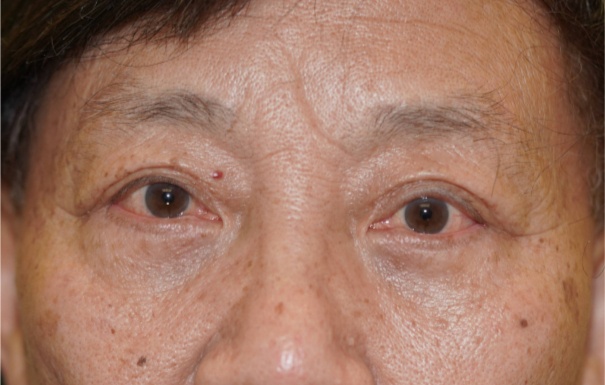 Patient # 5 After