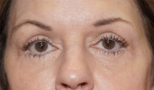 Patient # 7 After