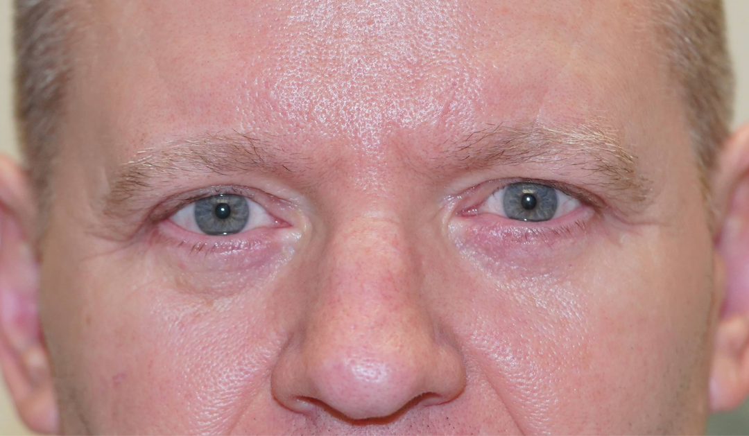 Patient # 8 After