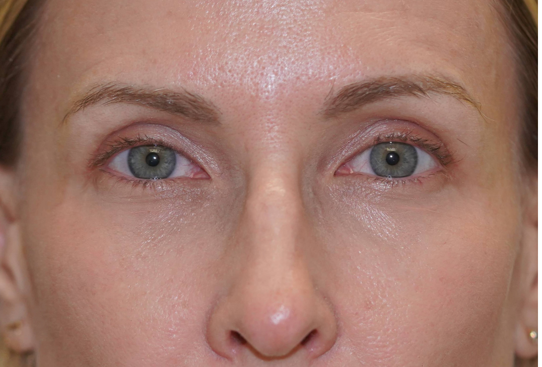 Patient # 9 After