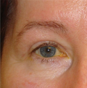 After after eyelid result