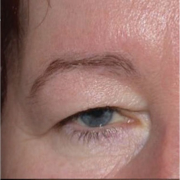 Before before eyelid result