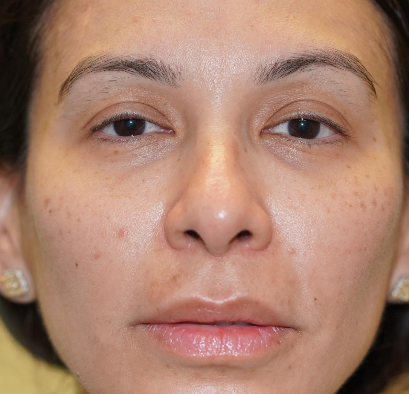 Before before eyelid result