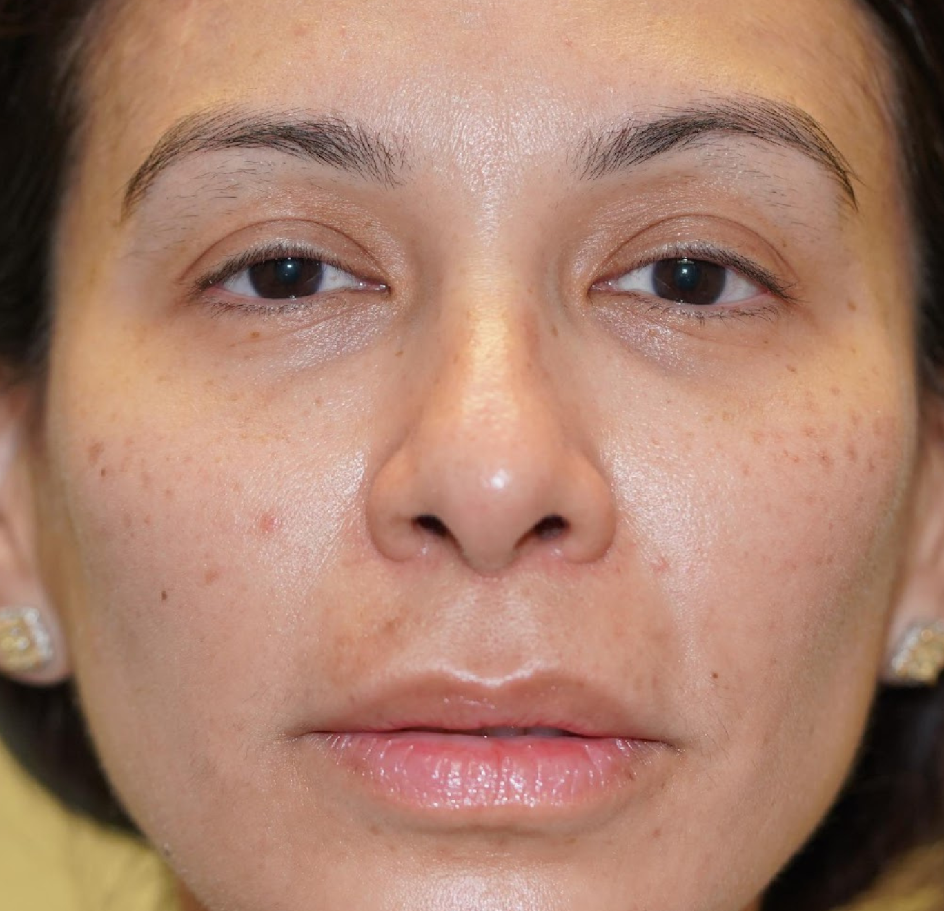 Midface Lift Before