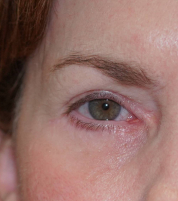 After after eyelid result