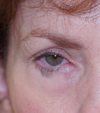 Before before eyelid result