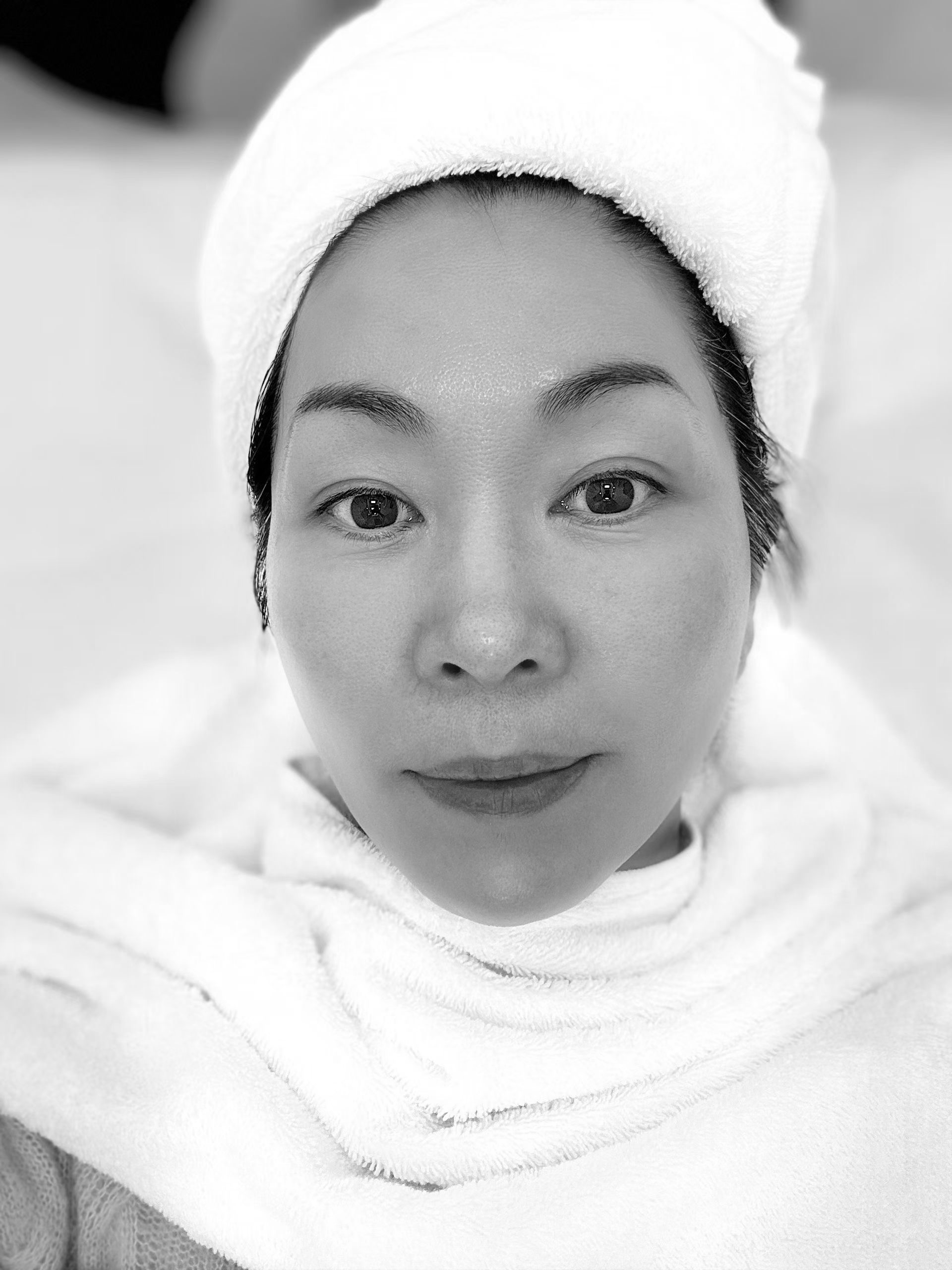 Non Surgical Skin Rejuvenation patient example