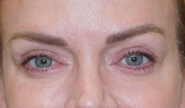 After after eyelid result