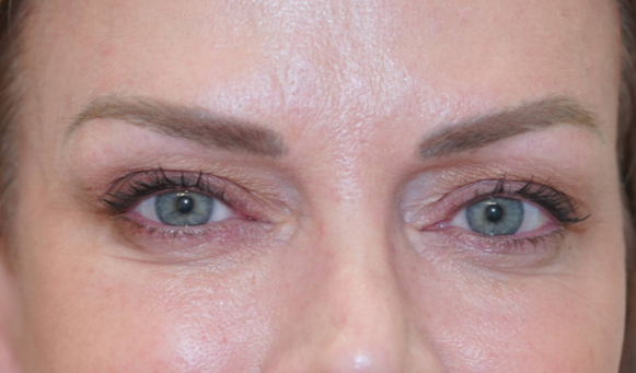 Before before eyelid result
