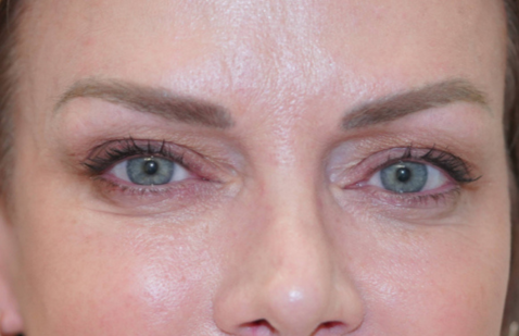 Upper Blepharoplasty Before